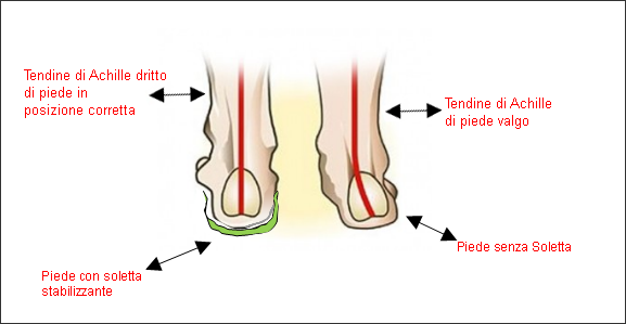 plantare stabilizzante